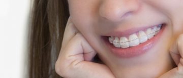 alinhamento dos dentes