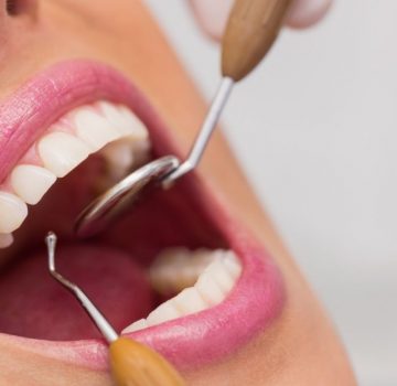 O que é Profilaxia dentária